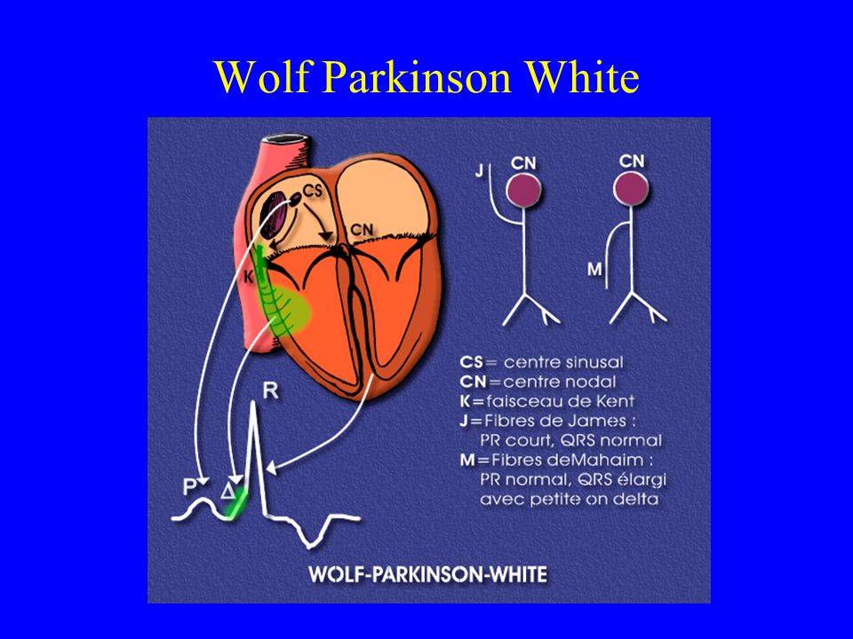 Wolf Parkinson White