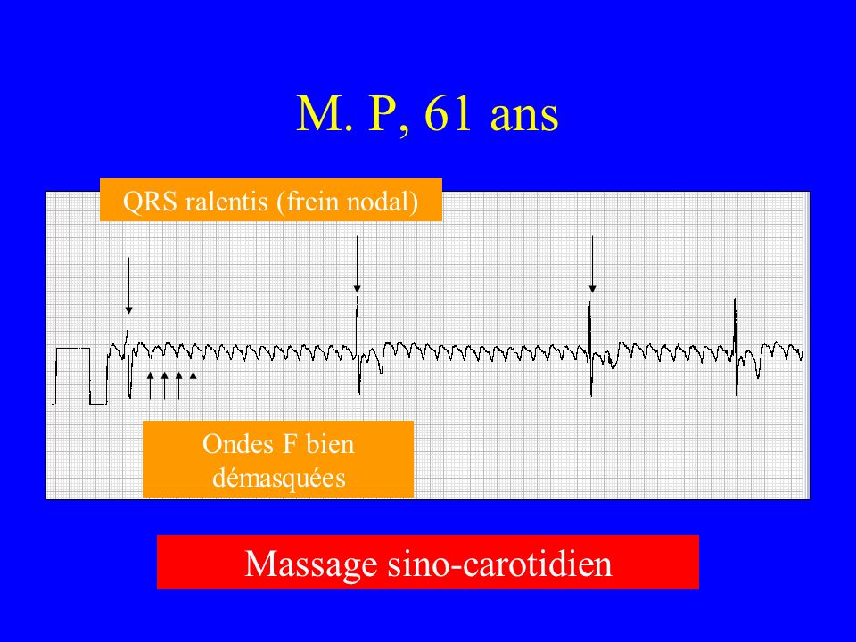 M. P, 61 ans Massage sino-carotidien QRS ralentis (frein nodal)