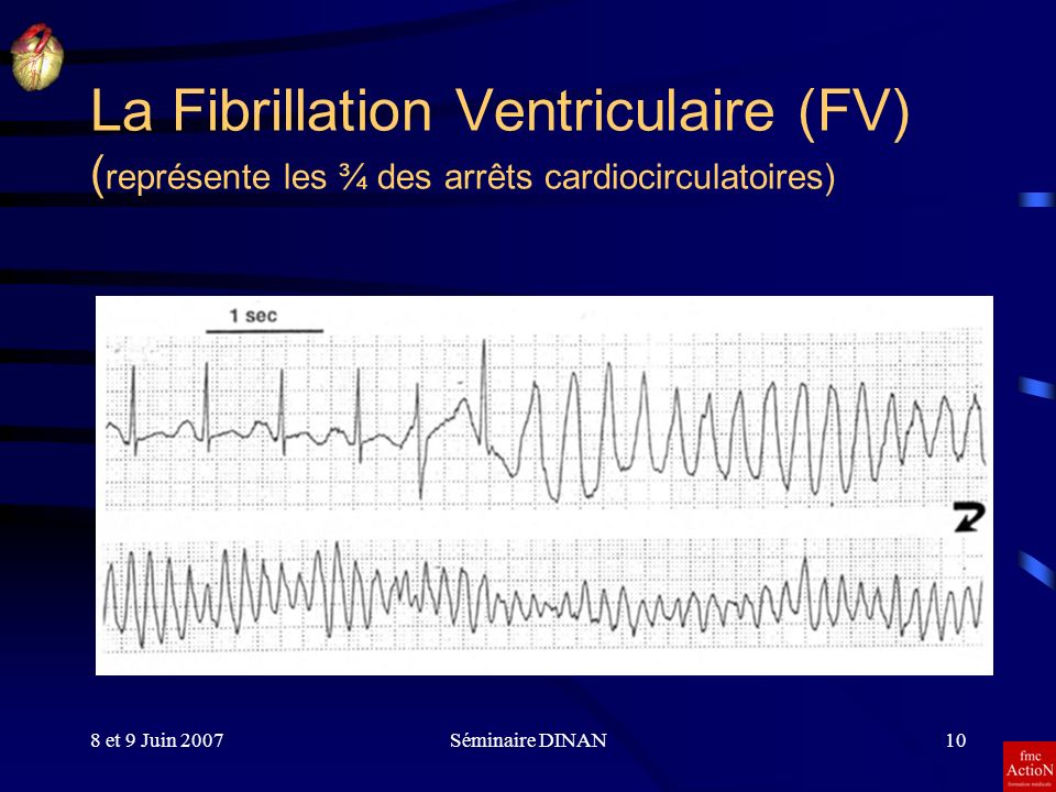 La Fibrillation Ventriculaire (FV) (représente les ¾ des arrêts cardiocirculatoires)
