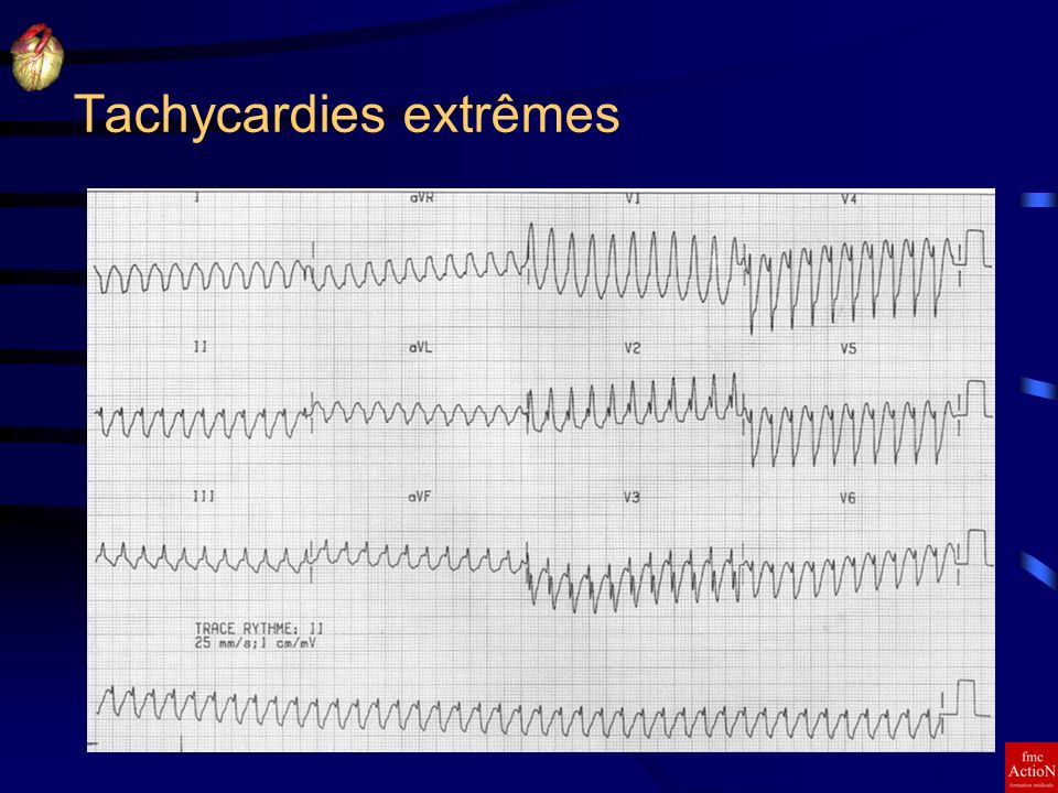 Tachycardies extrêmes