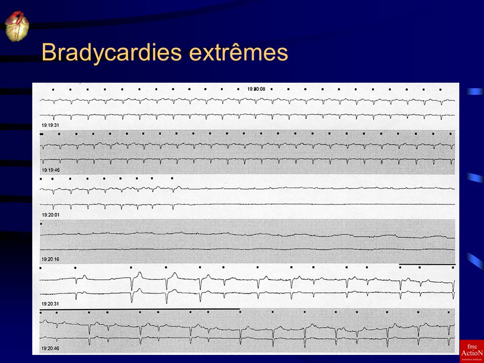 Bradycardies extrêmes