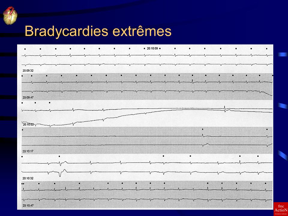 Bradycardies extrêmes