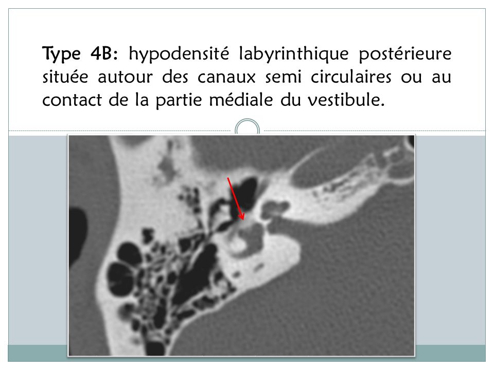 Type 4B: hypodensité labyrinthique postérieure située autour des canaux semi circulaires ou au contact de la partie médiale du vestibule.