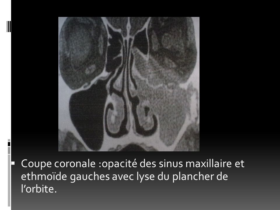 Coupe coronale :opacité des sinus maxillaire et ethmoïde gauches avec lyse du plancher de l’orbite.