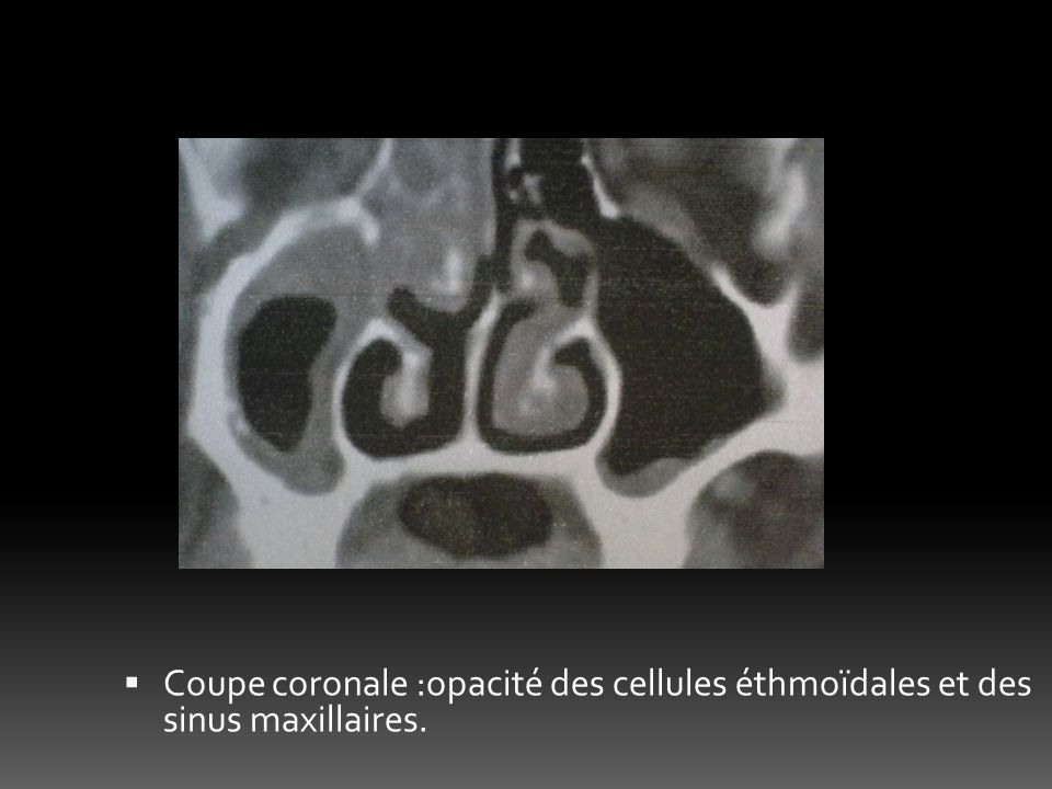 Coupe coronale :opacité des cellules éthmoïdales et des sinus maxillaires.