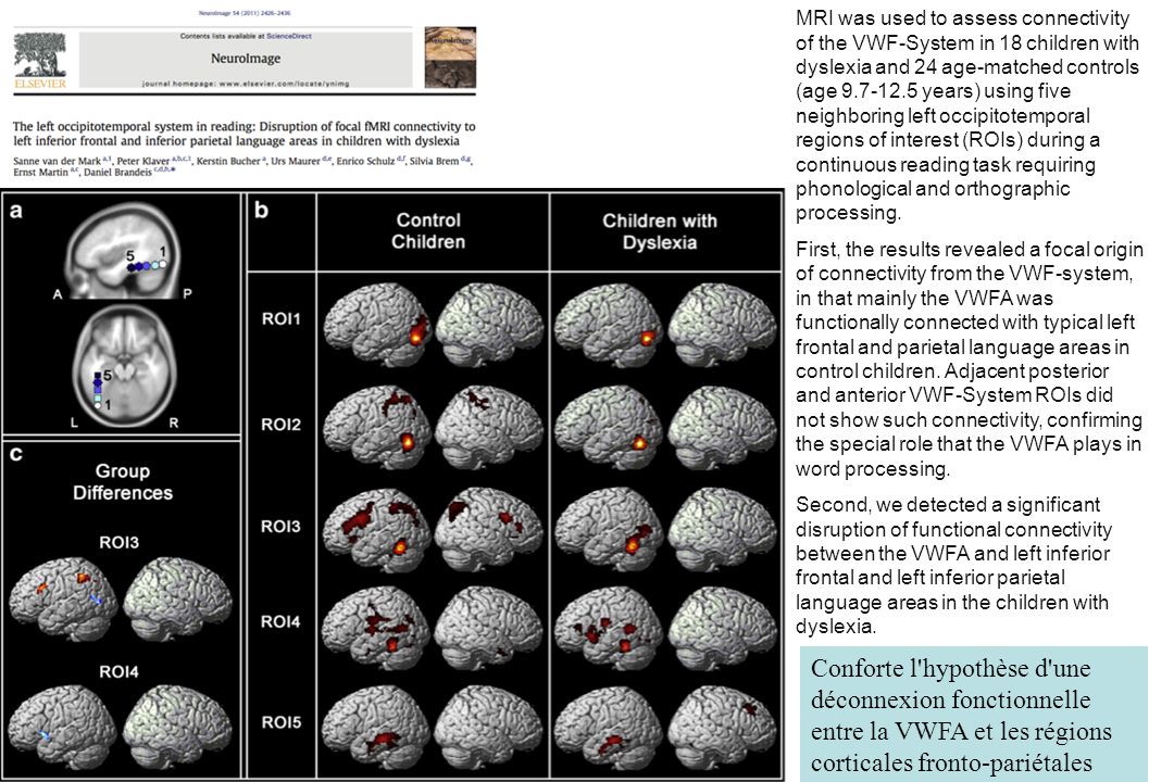 MRI was used to assess connectivity of the VWF-System in 18 children with dyslexia and 24 age-matched controls (age years) using five neighboring left occipitotemporal regions of interest (ROIs) during a continuous reading task requiring phonological and orthographic processing.