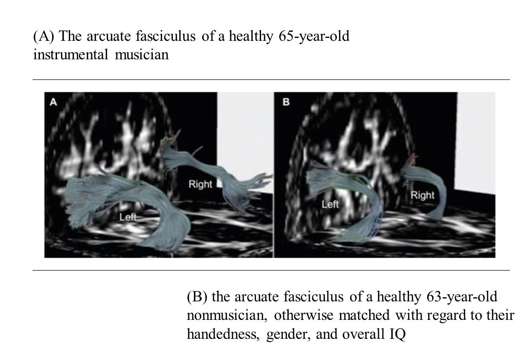 (A) The arcuate fasciculus of a healthy 65-year-old instrumental musician