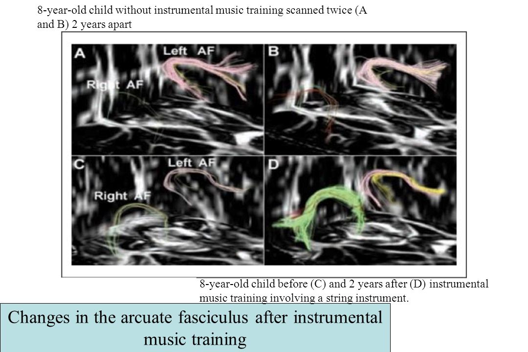 Changes in the arcuate fasciculus after instrumental music training