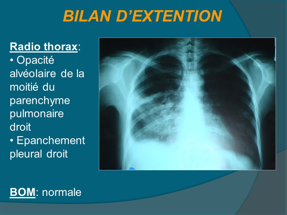 BILAN D’EXTENTION Radio thorax: