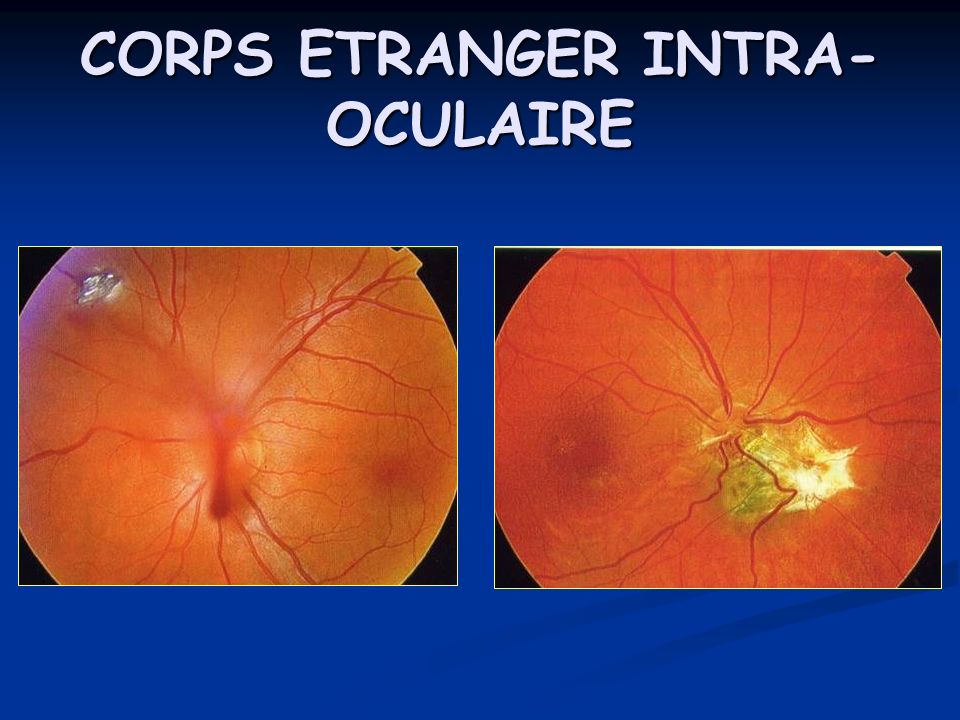 CORPS ETRANGER INTRA-OCULAIRE