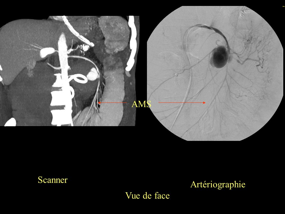 AMS Scanner Artériographie Vue de face