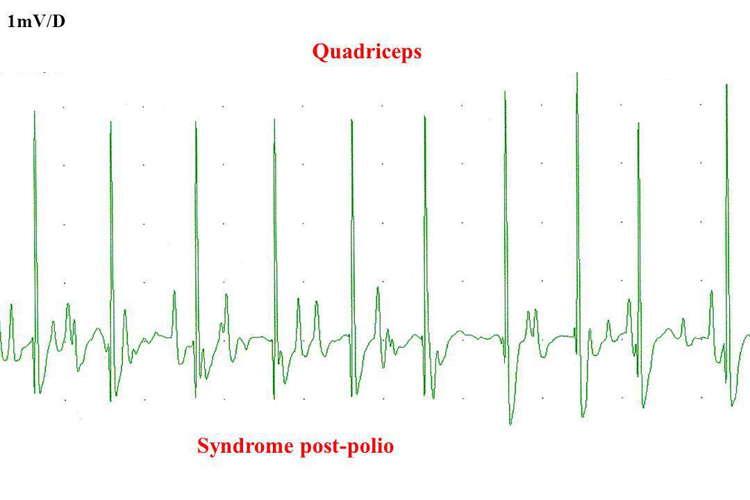 1mV/D Quadriceps Syndrome post-polio