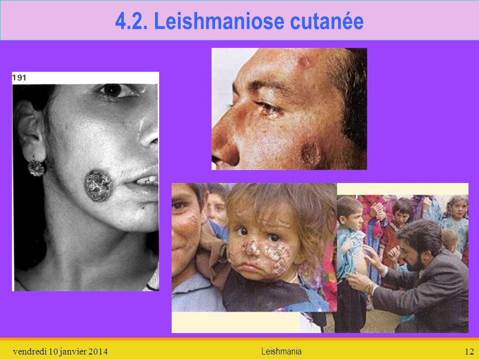 4.2. Leishmaniose cutanée dimanche 26 mars 2017 Leishmania