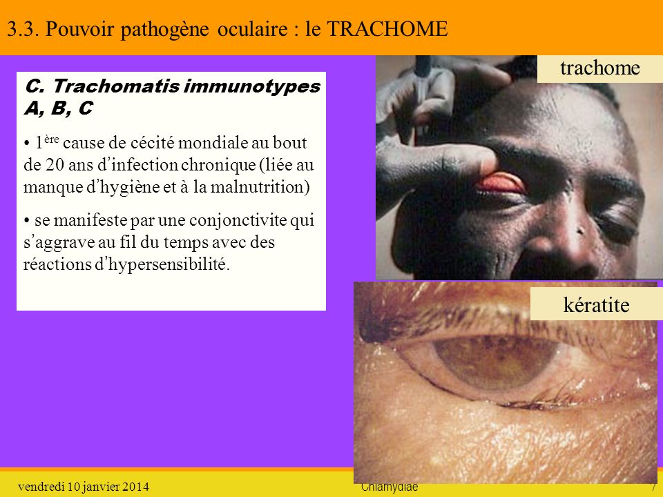 3.3. Pouvoir pathogène oculaire : le TRACHOME