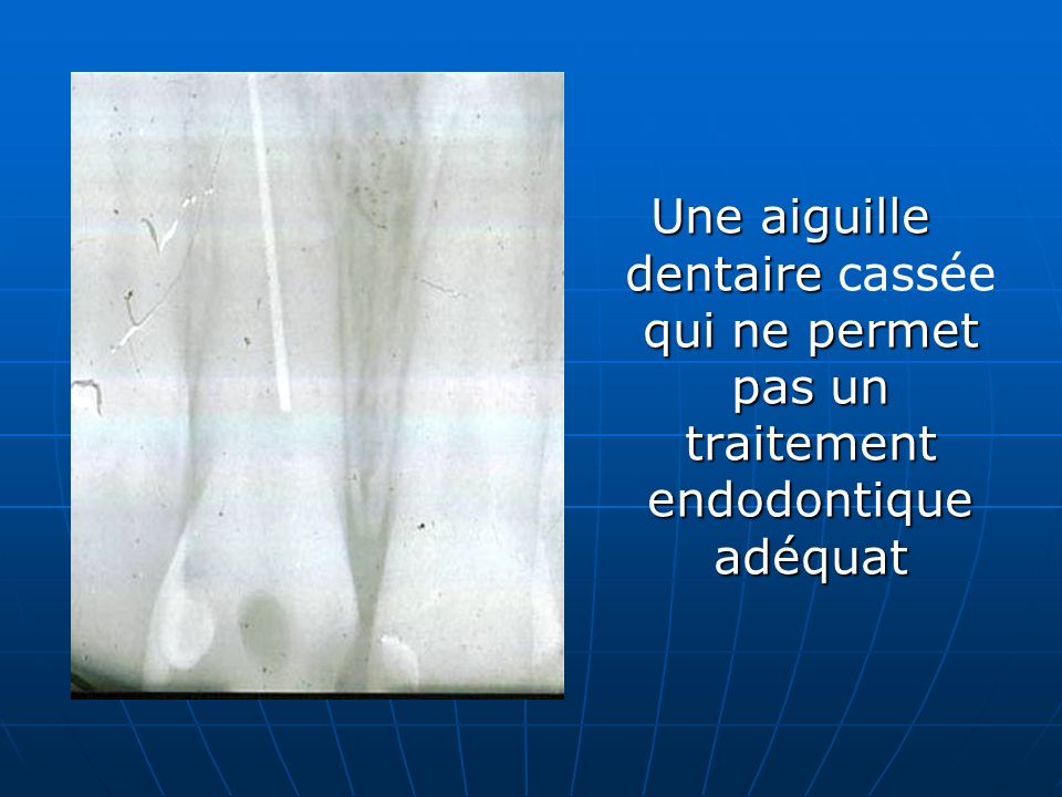 Une aiguille dentaire cassée qui ne permet pas un traitement endodontique adéquat