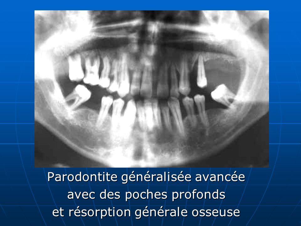 Parodontite généralisée avancée avec des poches profonds