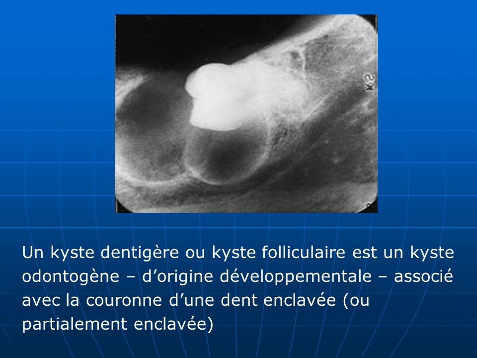 Un kyste dentigère ou kyste folliculaire est un kyste odontogène – d’origine développementale – associé avec la couronne d’une dent enclavée (ou partialement enclavée)