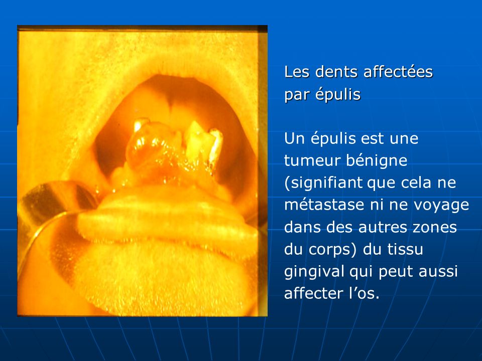 Les dents affectées par épulis Un épulis est une tumeur bénigne (signifiant que cela ne métastase ni ne voyage dans des autres zones du corps) du tissu gingival qui peut aussi affecter l’os.