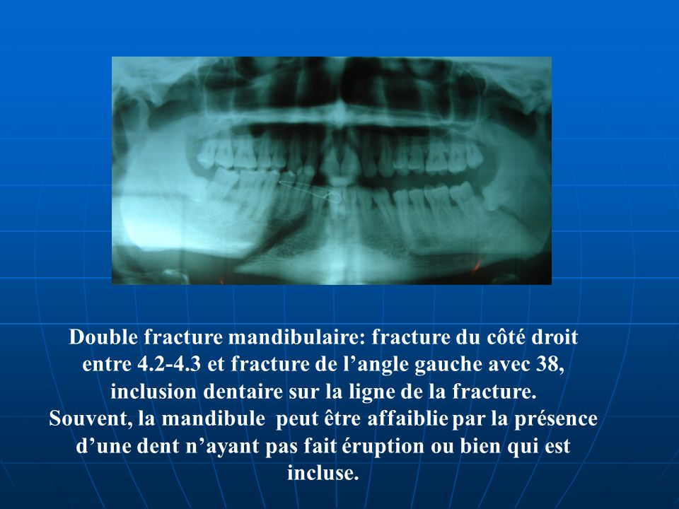 Double fracture mandibulaire: fracture du côté droit entre
