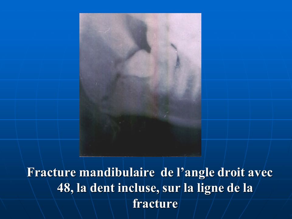 Fracture mandibulaire de l’angle droit avec 48, la dent incluse, sur la ligne de la fracture