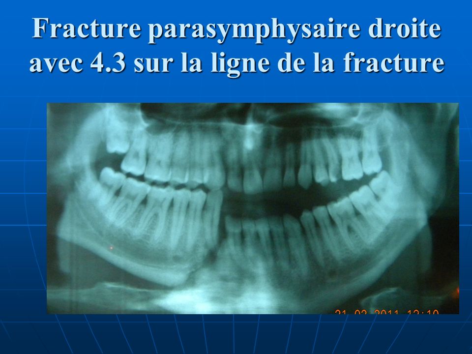 Fracture parasymphysaire droite avec 4.3 sur la ligne de la fracture