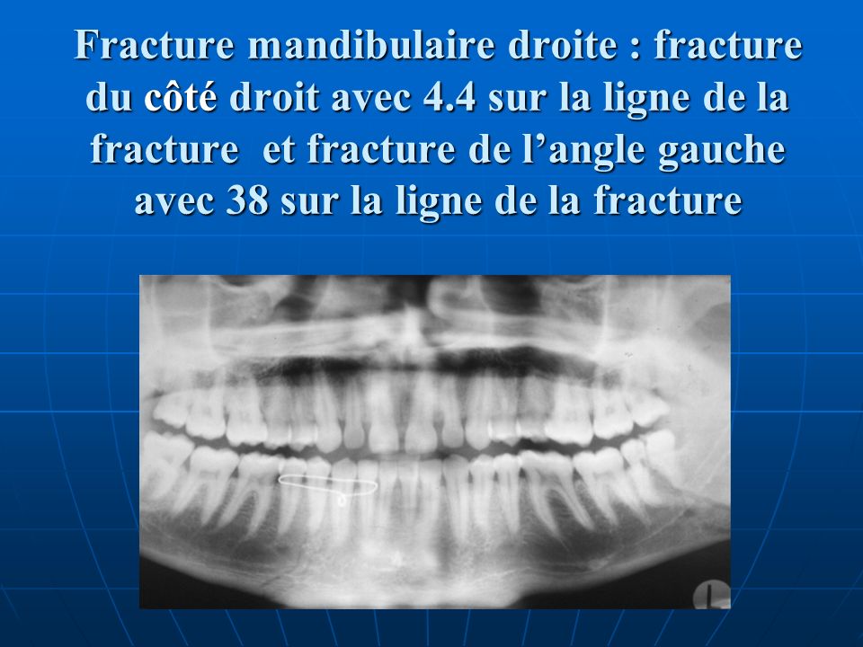 Fracture mandibulaire droite : fracture du côté droit avec 4