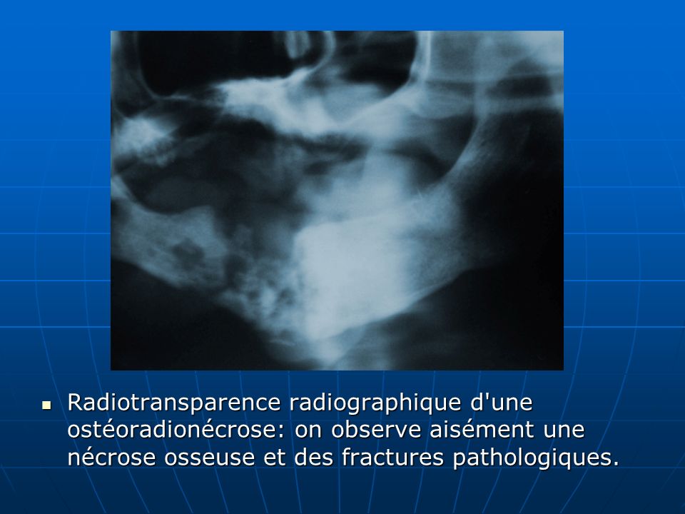Radiotransparence radiographique d une ostéoradionécrose: on observe aisément une nécrose osseuse et des fractures pathologiques.