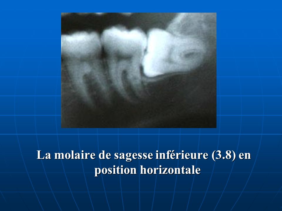 La molaire de sagesse inférieure (3.8) en position horizontale