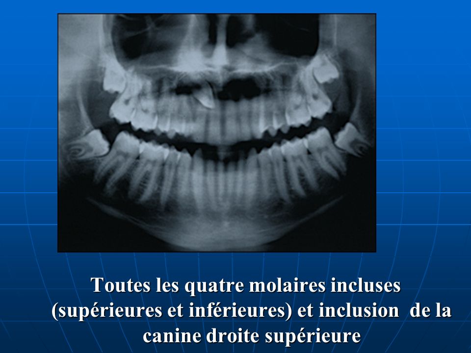 Toutes les quatre molaires incluses (supérieures et inférieures) et inclusion de la canine droite supérieure