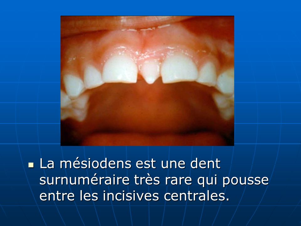 La mésiodens est une dent surnuméraire très rare qui pousse entre les incisives centrales.