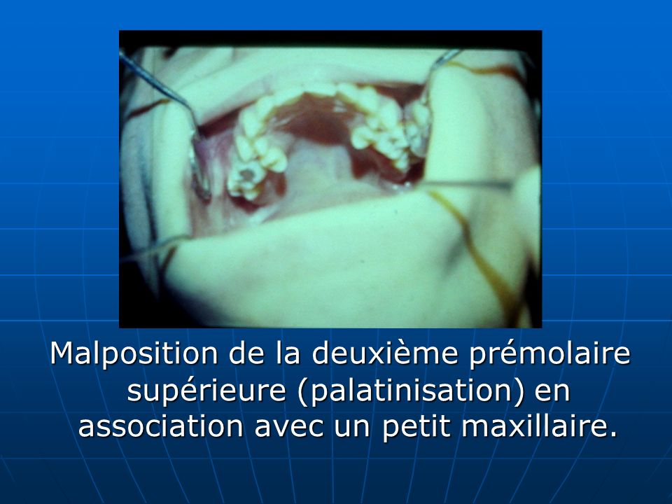 Malposition de la deuxième prémolaire supérieure (palatinisation) en association avec un petit maxillaire.