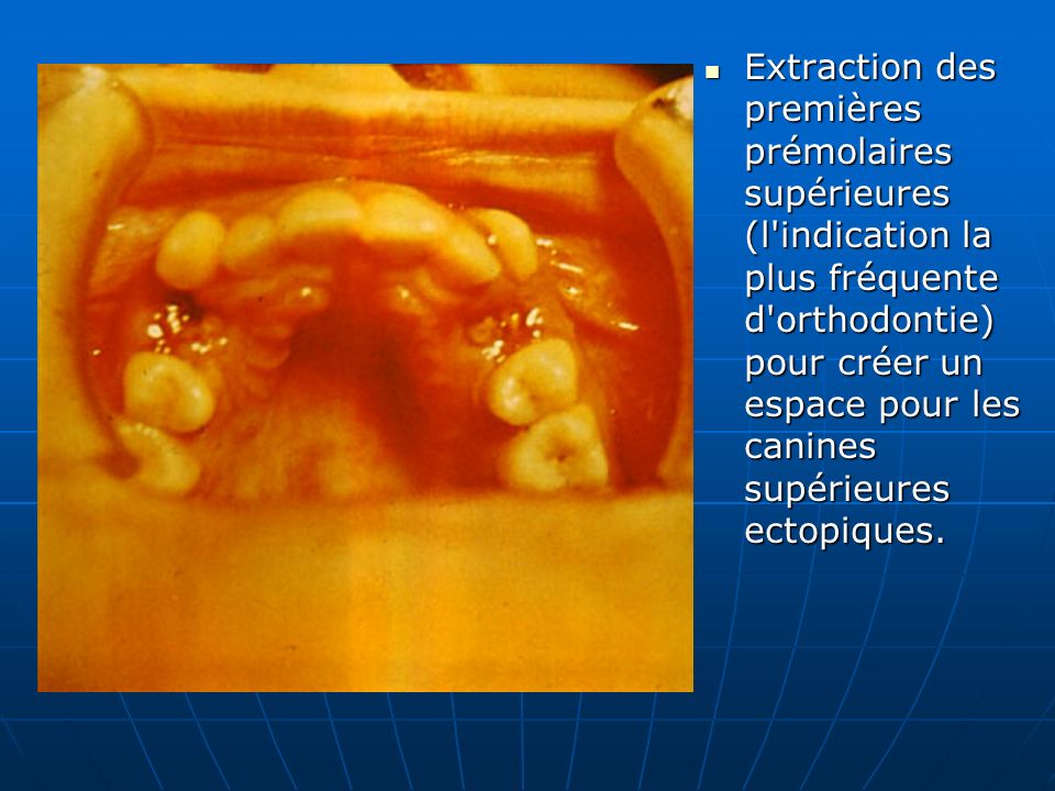 Extraction des premières prémolaires supérieures (l indication la plus fréquente d orthodontie) pour créer un espace pour les canines supérieures ectopiques.