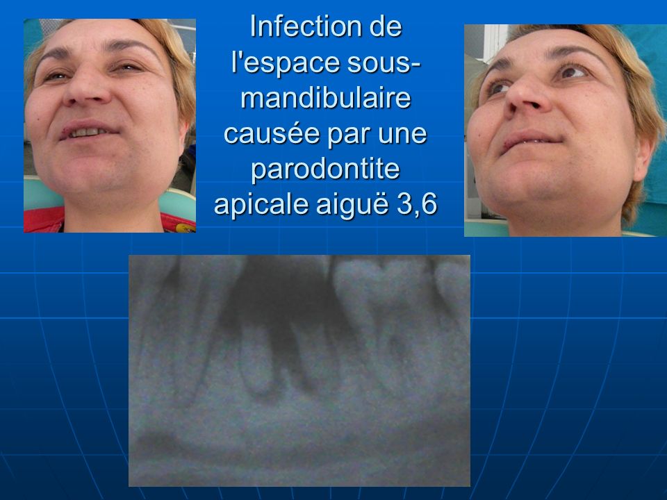 Infection de l espace sous-mandibulaire causée par une parodontite apicale aiguë 3,6
