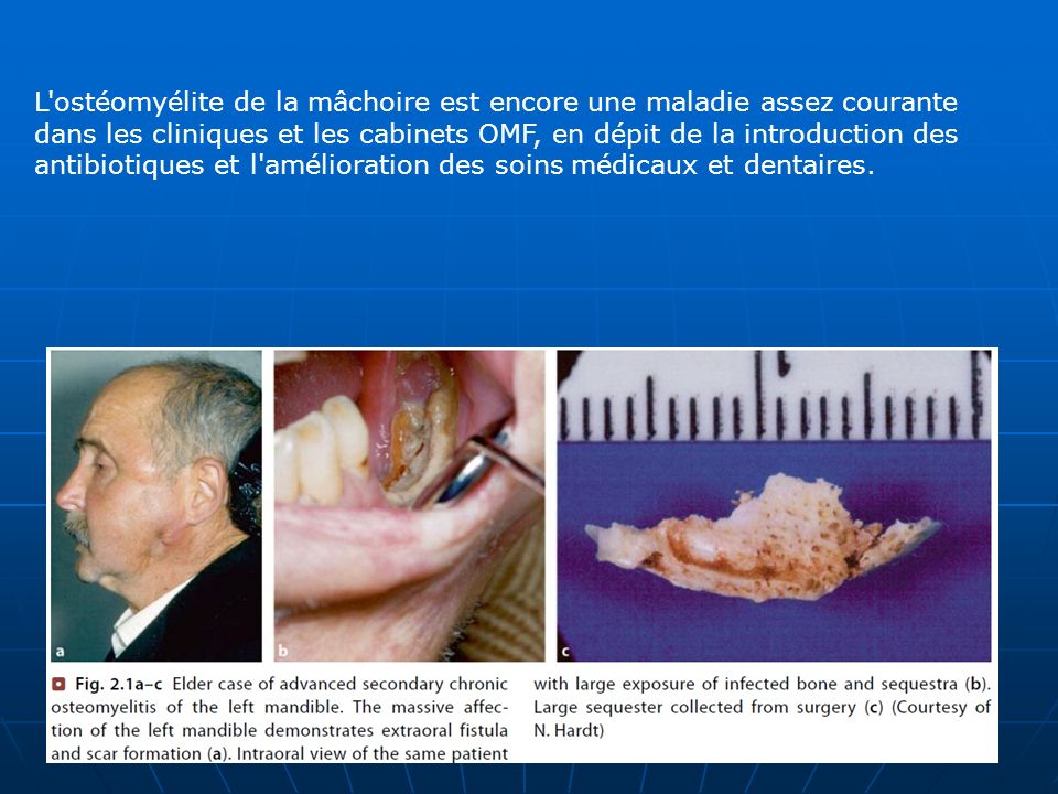 L ostéomyélite de la mâchoire est encore une maladie assez courante dans les cliniques et les cabinets OMF, en dépit de la introduction des