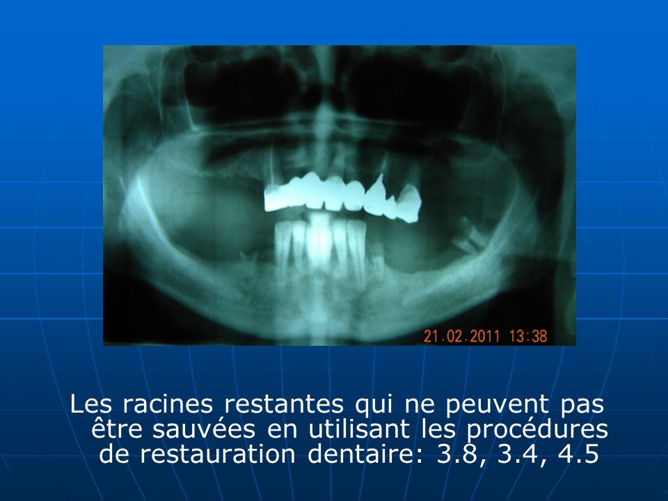 Les racines restantes qui ne peuvent pas être sauvées en utilisant les procédures de restauration dentaire: 3.8, 3.4, 4.5