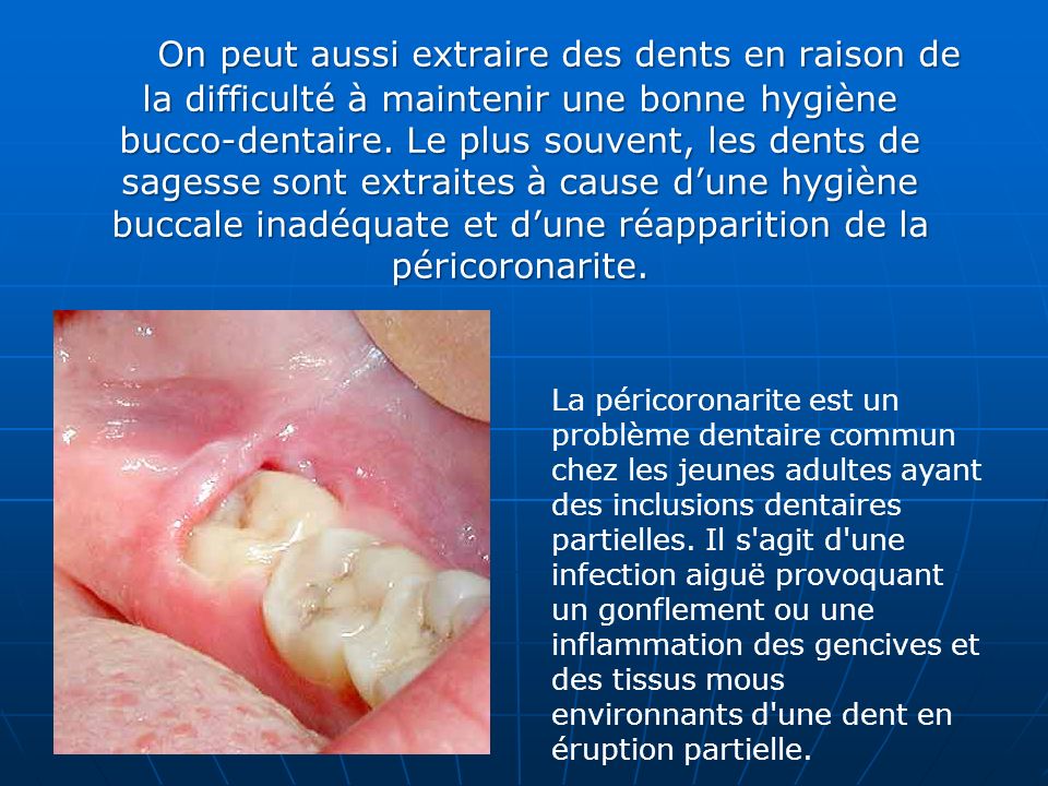 On peut aussi extraire des dents en raison de la difficulté à maintenir une bonne hygiène bucco-dentaire. Le plus souvent, les dents de sagesse sont extraites à cause d’une hygiène buccale inadéquate et d’une réapparition de la péricoronarite.