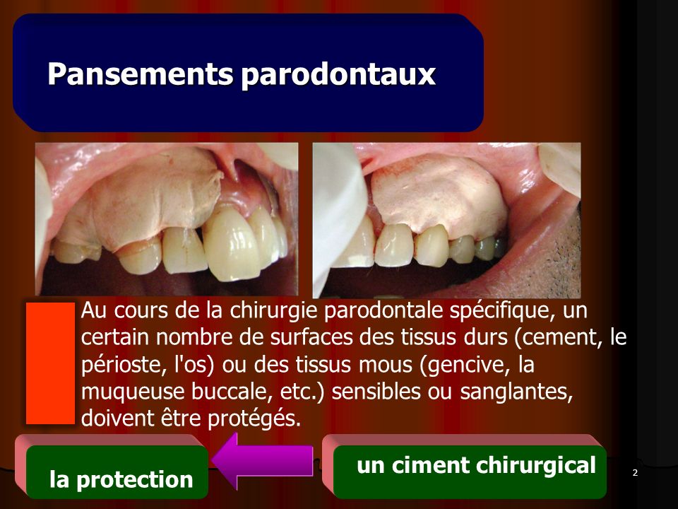 https://slideplayer.fr/slide/458256/1/images/2/Pansements+parodontaux.jpg