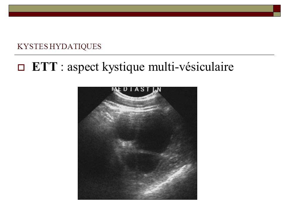 ETT : aspect kystique multi-vésiculaire