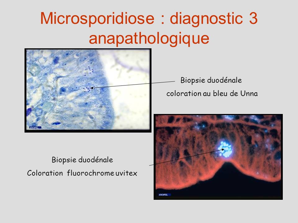 Microsporidiose : diagnostic 3 anapathologique