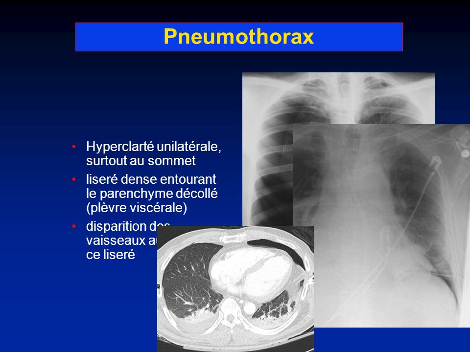 Pneumothorax Hyperclarté unilatérale, surtout au sommet