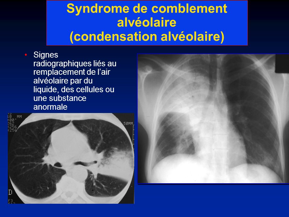 Syndrome de comblement alvéolaire (condensation alvéolaire)