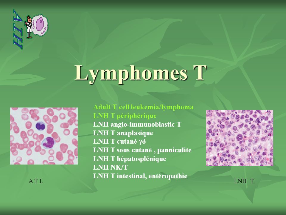 Lymphomes T Adult T cell leukemia/lymphoma LNH T périphérique