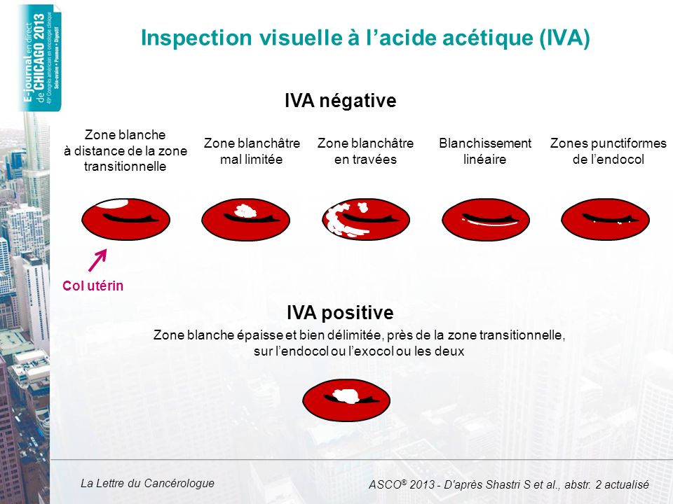 Inspection visuelle à l’acide acétique (IVA)