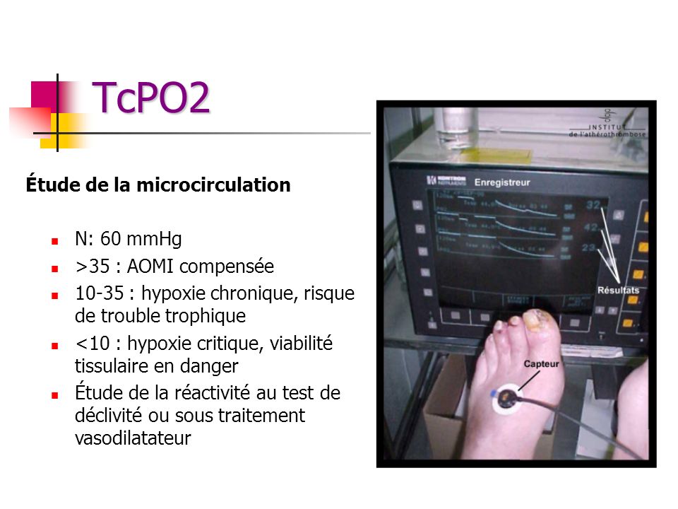 TcPO2 Étude de la microcirculation N: 60 mmHg >35 : AOMI compensée
