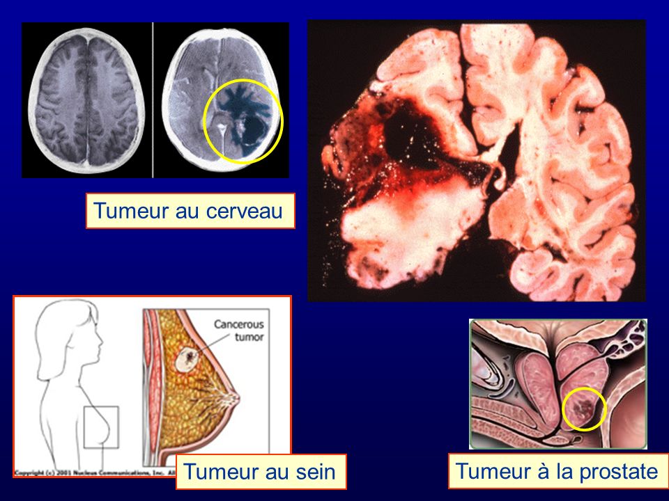 Tumeur au cerveau Tumeur au sein Tumeur à la prostate