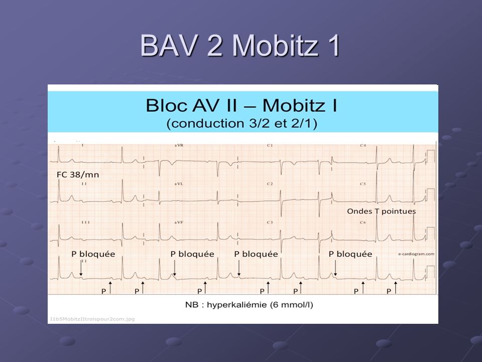 BAV 2 Mobitz 1