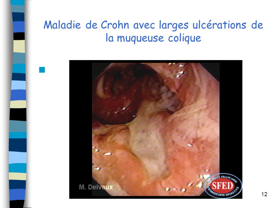 Maladie de Crohn avec larges ulcérations de la muqueuse colique