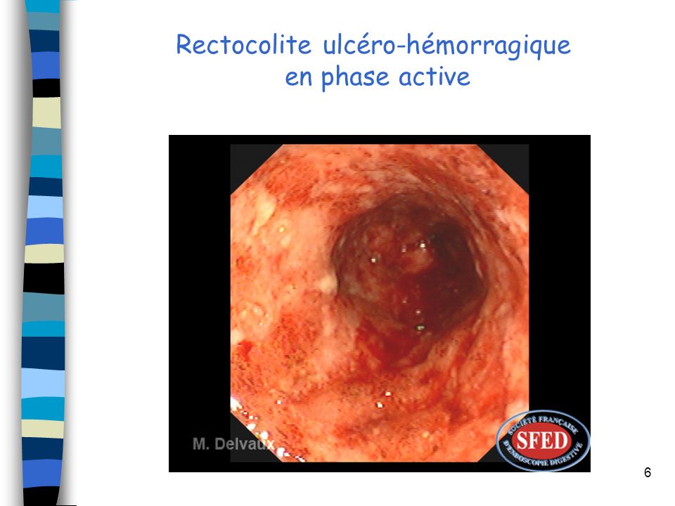 Rectocolite ulcéro-hémorragique en phase active