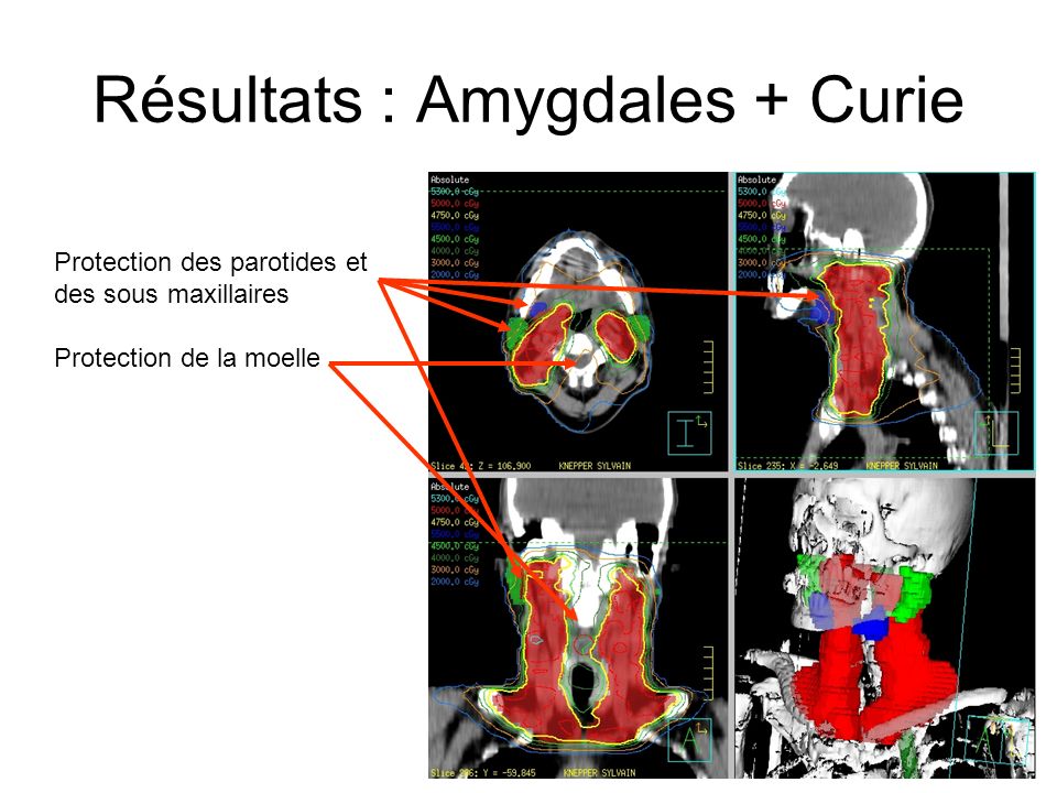 Résultats : Amygdales + Curie