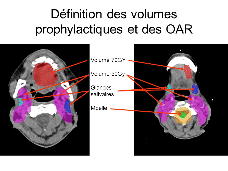Définition des volumes prophylactiques et des OAR